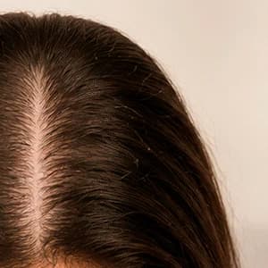 Risca do cabelo mais larga, com o couro cabeludo aparecendo na divisão